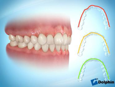 Aligner tray illustration