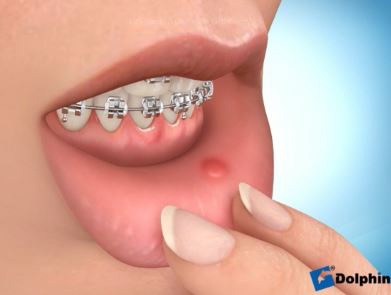 Brace irritation illustration