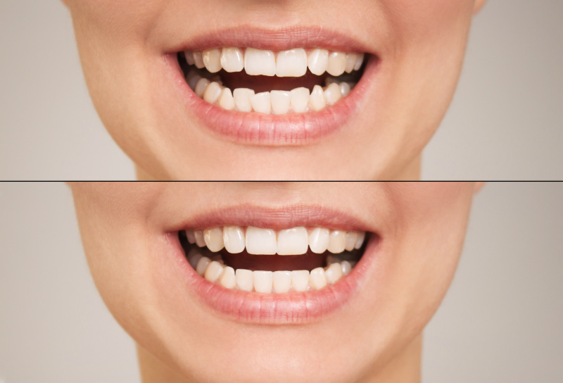 Before and after photos showing dramatic adult smile improvement with orthodontic treatment