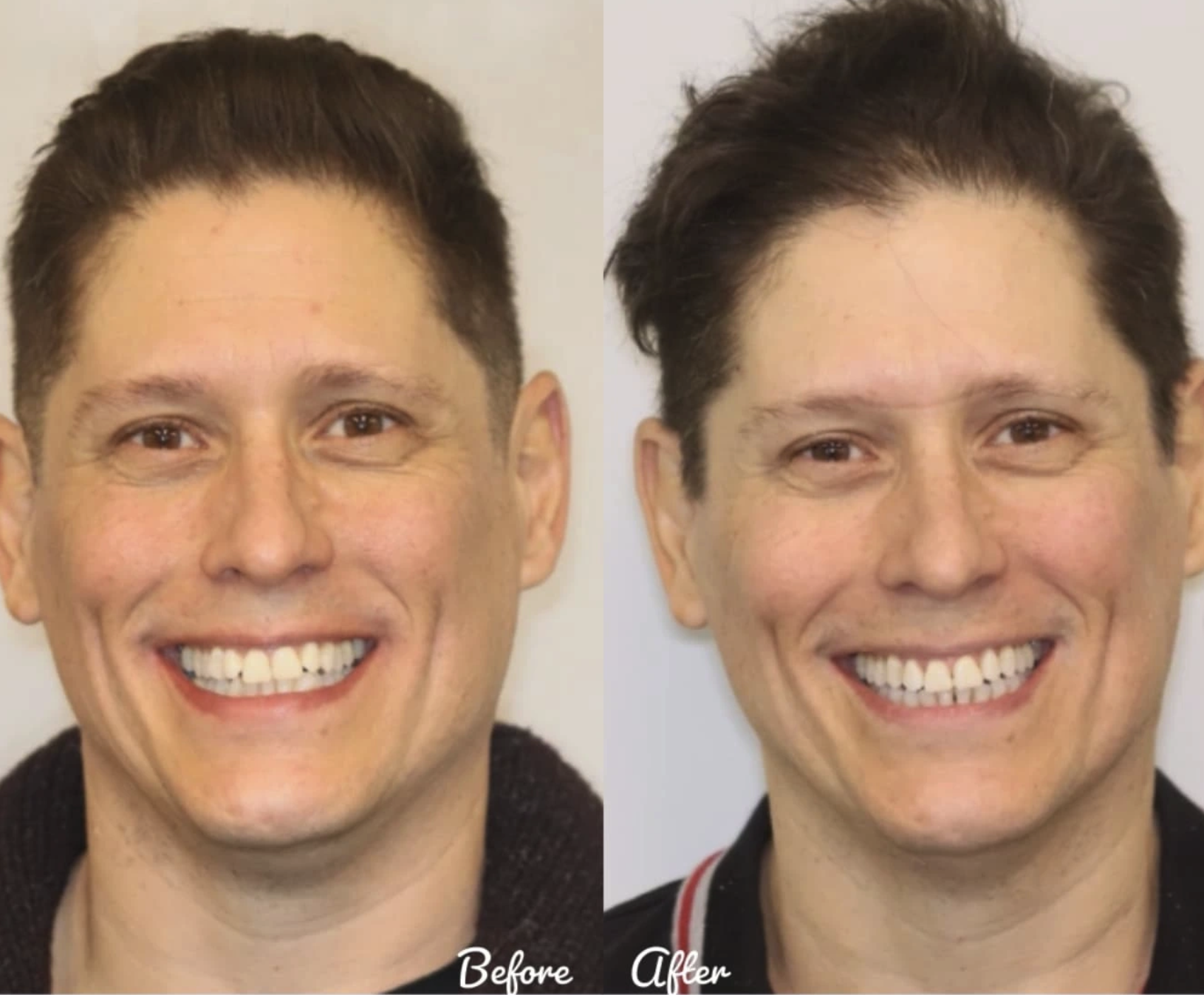 Before and after photos showing adult orthodontic treatment results
