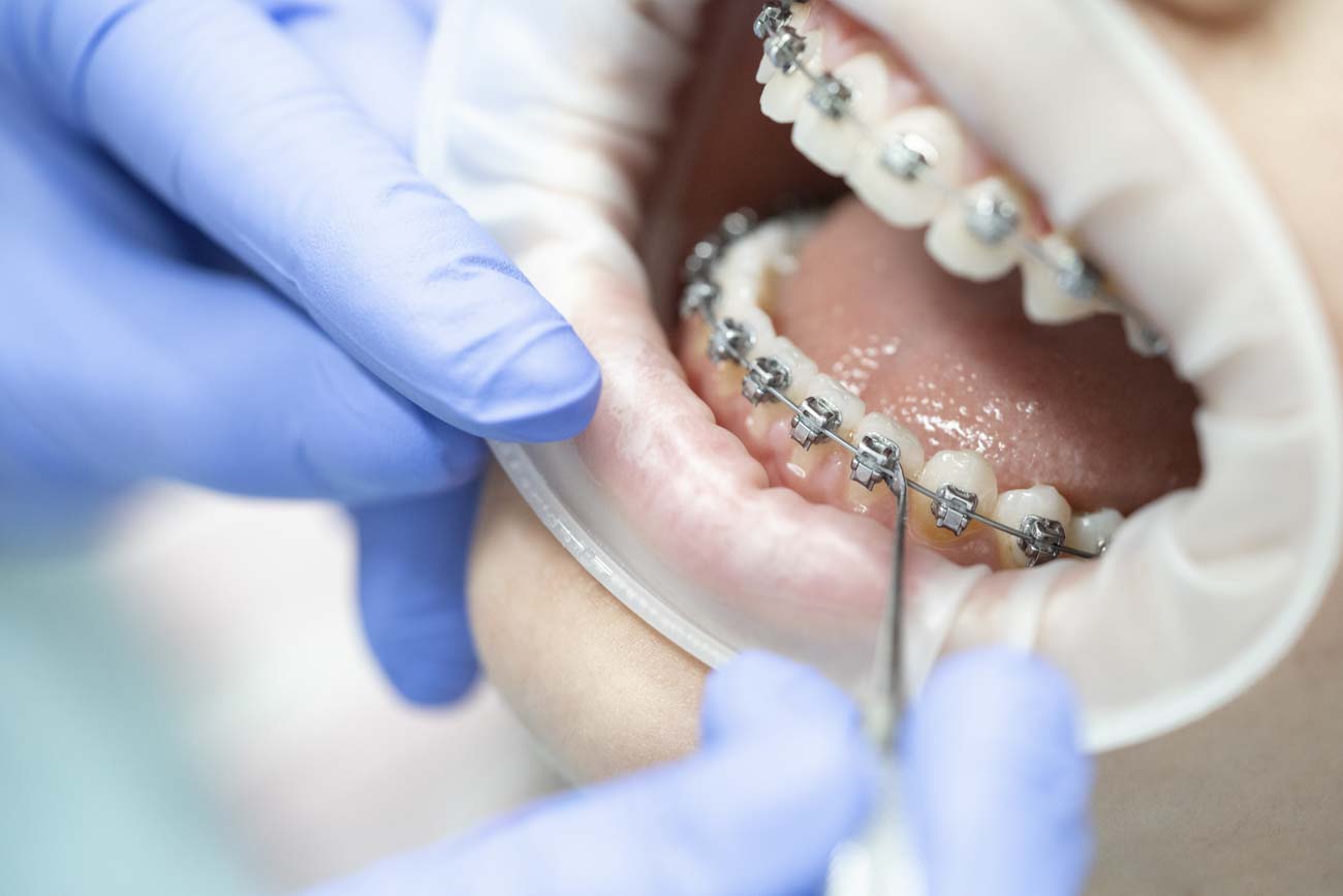 orthodontist adjusting Portland dental braces