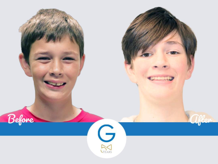 smiling patient before and after braces comparison